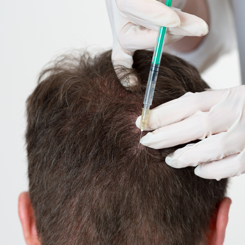 Mesotherapy of the scalp consists of multiple superficial injections of a mixture of vitamins.