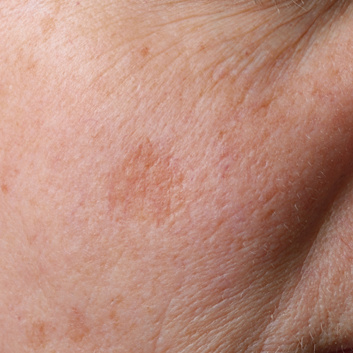 There are two main types of pigment spots: melasma and lentigo.