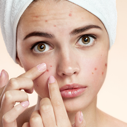 L’acné est une maladie de peau chronique, inflammatoire, du follicule pilosébacé.