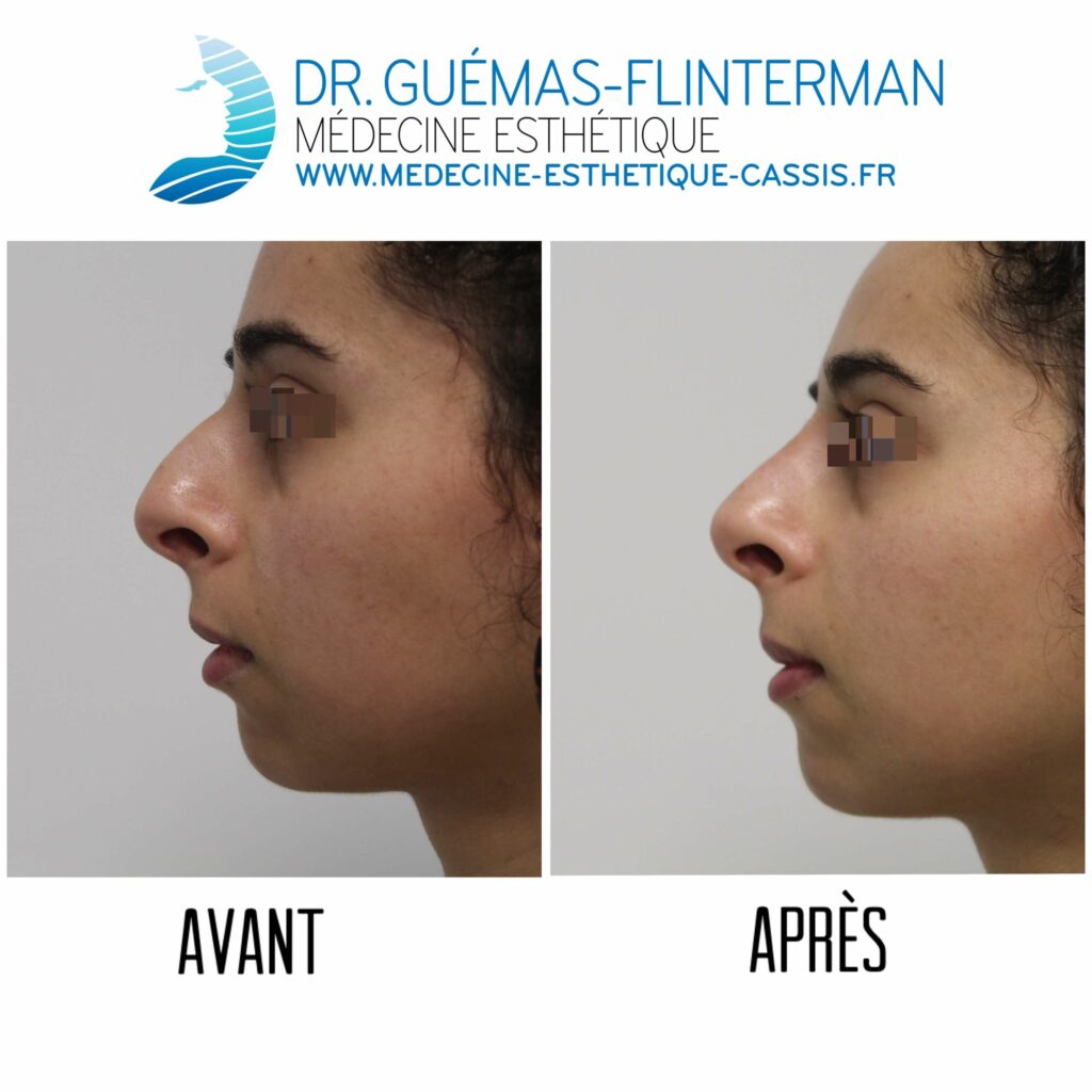 acide hyaluronique rhinoplastie