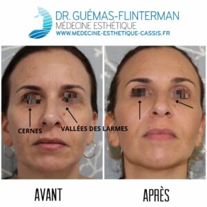 cernes vallees des larmes avant apres