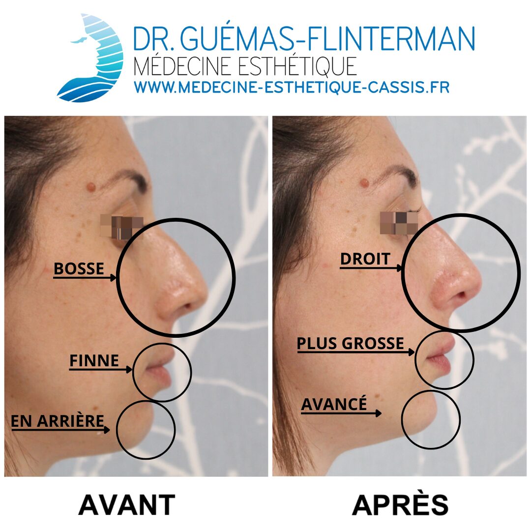 profiloplastie avant apres