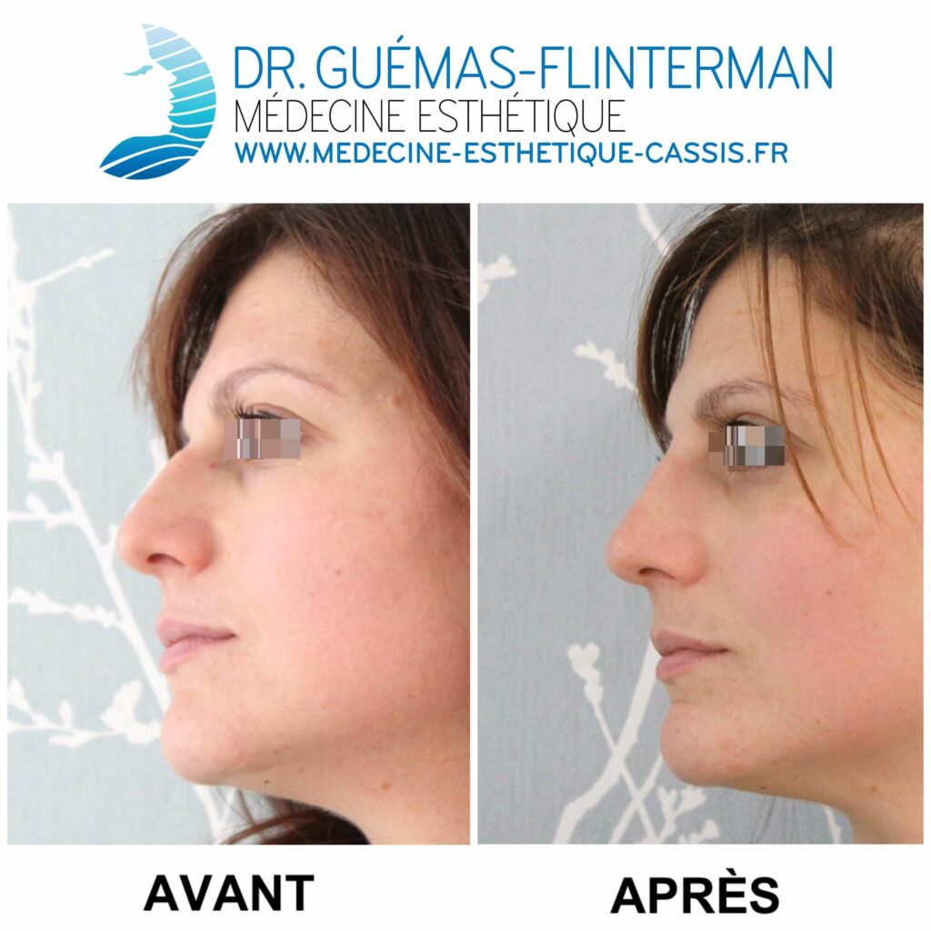 rhinoplastie medicale