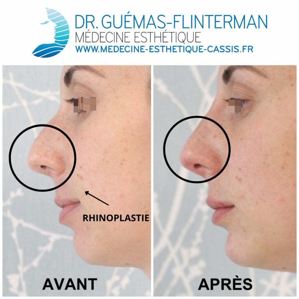 rhinoplastie medicale avant apres