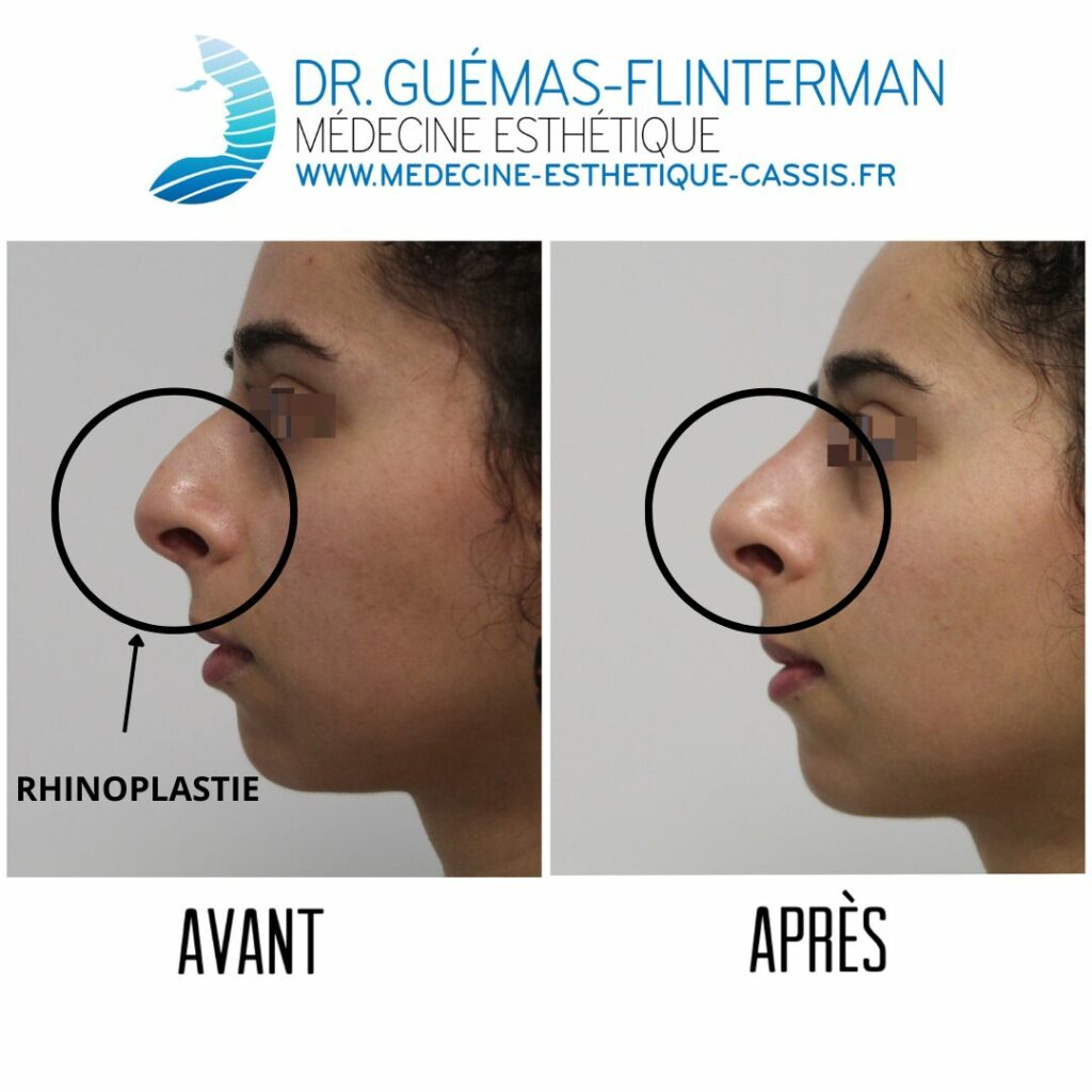 rhinoplastie medicale avant apres 2